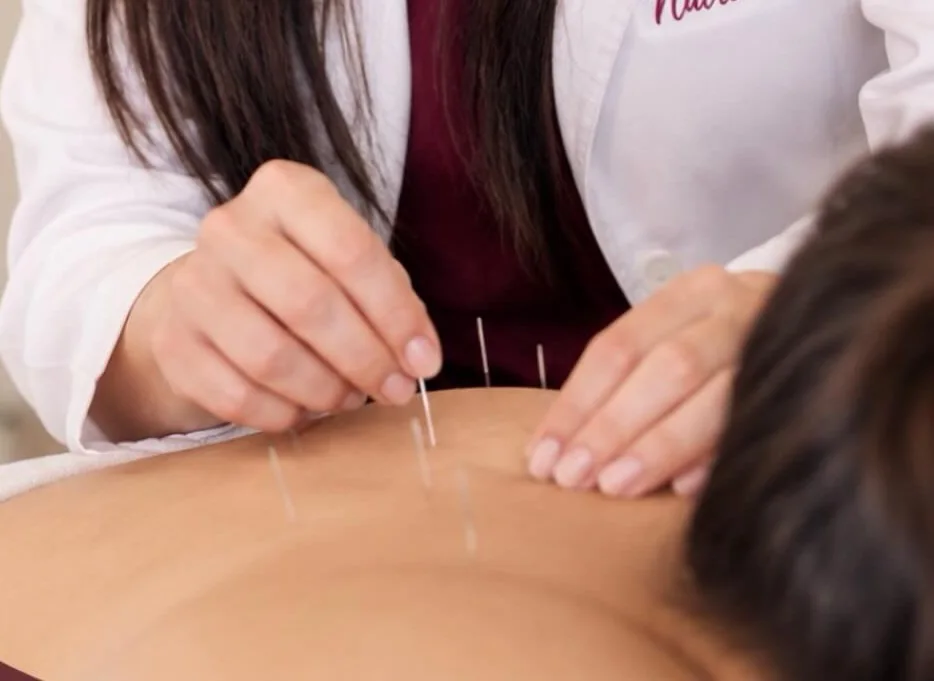 Mãos da fisioterapeuta aplicando agulhas de acupuntura nas costas de um paciente